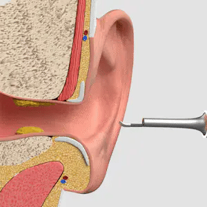 Arilom® - Pulizia auricolare intelligente con tecnologia avanzata
